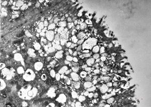 celiakia celiakia